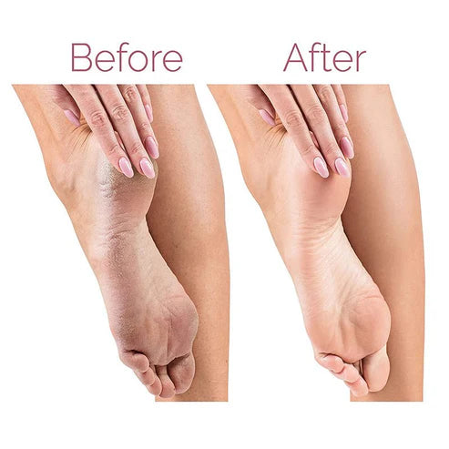 Electric Foot File Callus Remover – Rechargeable Pedicure Tool for Smooth Feet